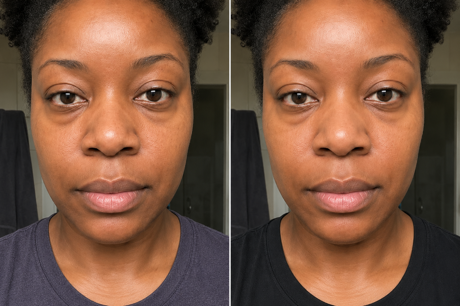 Before and after - under-eye puffiness